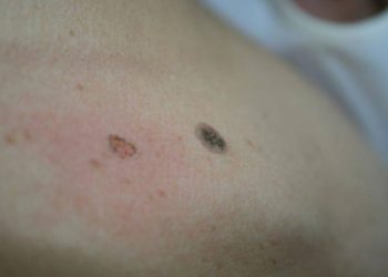 Comment Attrape-t-on la dermite séborrhéique ?