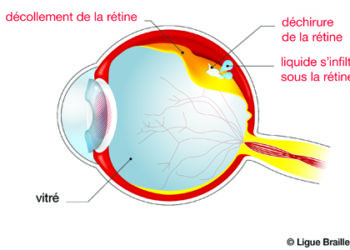 Qu'est-ce qui provoque le décollement de la rétine ?