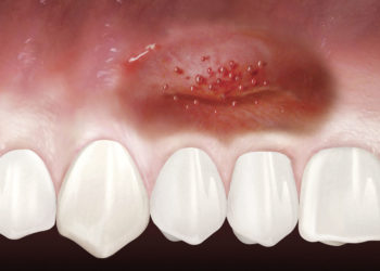 Comment calmer une gencive enflammée ?