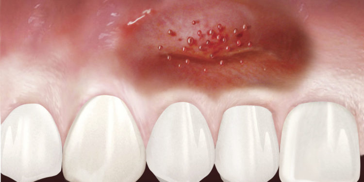 Comment calmer une gencive enflammée ?