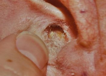 Comment soigner de l'eczéma dans l'oreille ?