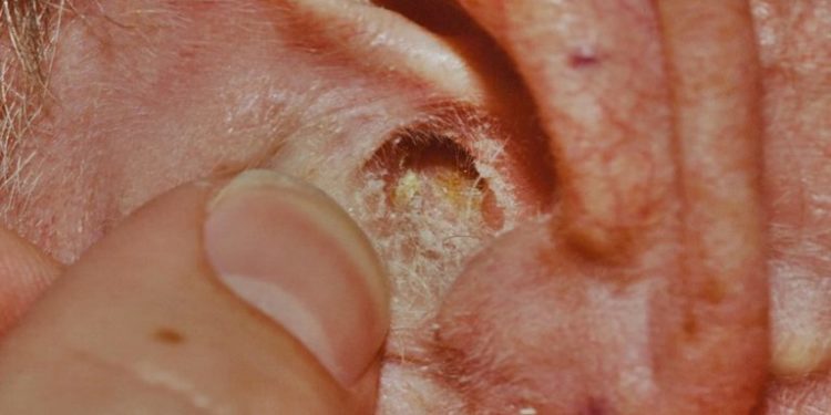 Comment soigner de l'eczéma dans l'oreille ?