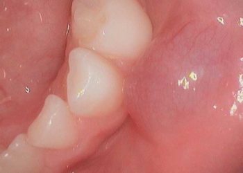 Comment soigner une boule dans la bouche ?