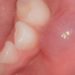 Comment soigner une boule dans la bouche ?