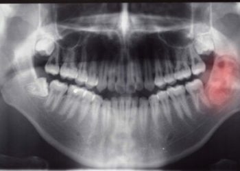 Comment Attrape-t-on un cancer de la mâchoire ?