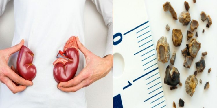 Quel aliment provoque des calculs rénaux ?