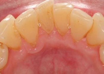 Comment faire un Detartrage des dents à la maison ?