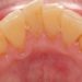 Comment faire un Detartrage des dents à la maison ?