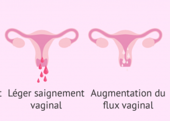 Comment différencier symptôme prémenstruel et grossesse ?