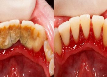 Comment faire un détartrage des dents à la maison ?