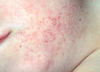 Comment partent les pétéchies ?