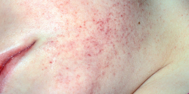 Comment partent les pétéchies ?