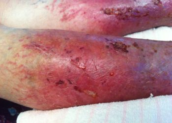 Comment sortir les vers d'une plaie ?