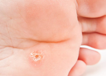 Comment guérir d'une pneumonie ?