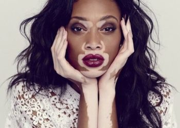 Est-ce que le vitiligo peut disparaître ?