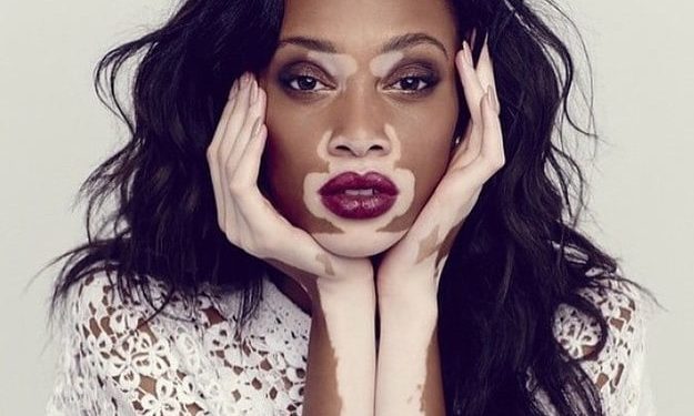 Est-ce que le vitiligo peut disparaître ?