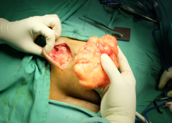 Comment faire dégonfler un lipome ?