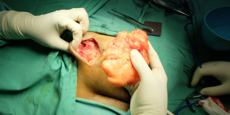 Comment faire dégonfler un lipome ?