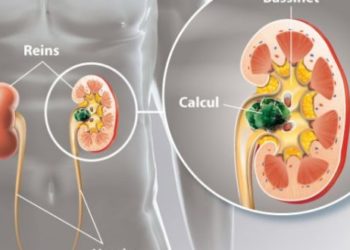 Comment soulager la douleur d'un calcul rénal ?
