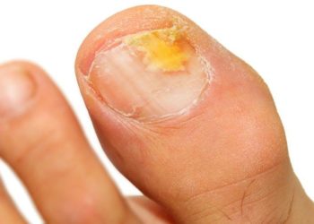 Comment se débarrasser de la gale remède de Grand-mère ?