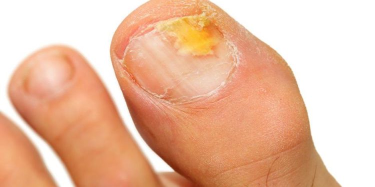 Comment se débarrasser de la gale remède de Grand-mère ?