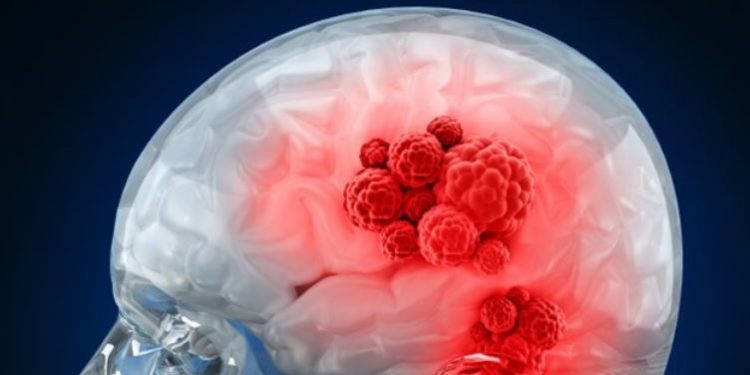 C'est quoi une tumeur bénigne ?