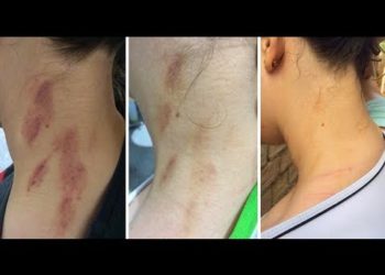 Comment faire partir la gale rapidement ?