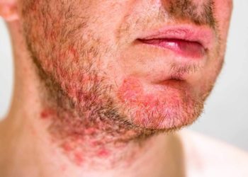 Qu'est-ce qui provoque la dermite séborrhéique ?