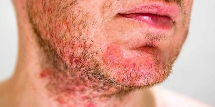 Qu'est-ce qui provoque la dermite séborrhéique ?