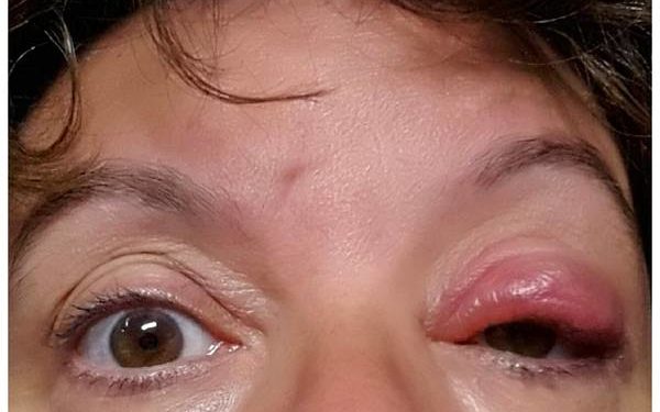 Comment soigner l'œil d'une poule ?