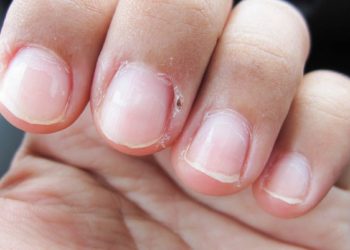 Comment soigner un scarabée ?