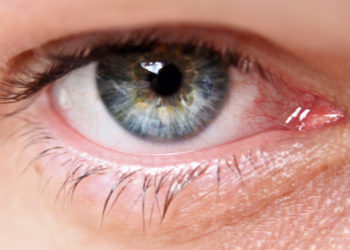 Quel est le traitement du glaucome ?