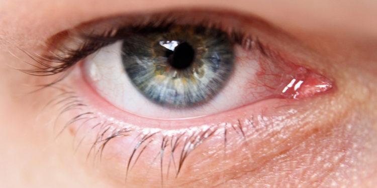 Quel est le traitement du glaucome ?