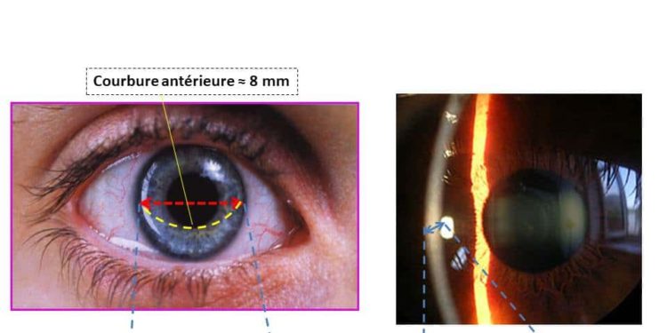 Comment cicatriser la cornée de l'œil ?