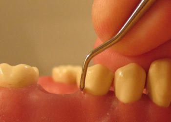 Quelles sont les douleurs d'une parodontite ?