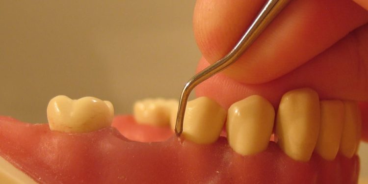 Quelles sont les douleurs d'une parodontite ?