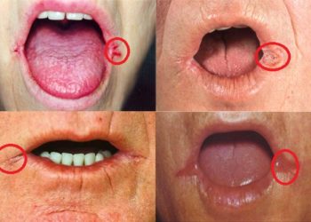 Comment traiter naturellement les blessures de la bouche ?