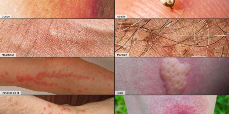 Quelle pommade pour une piqûre d'araignée ?