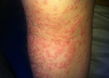 Comment calmer les boutons de chenille processionnaire ?