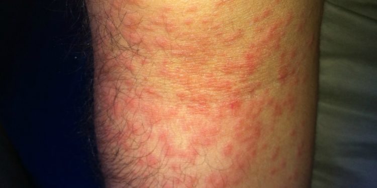 Comment calmer les boutons de chenille processionnaire ?