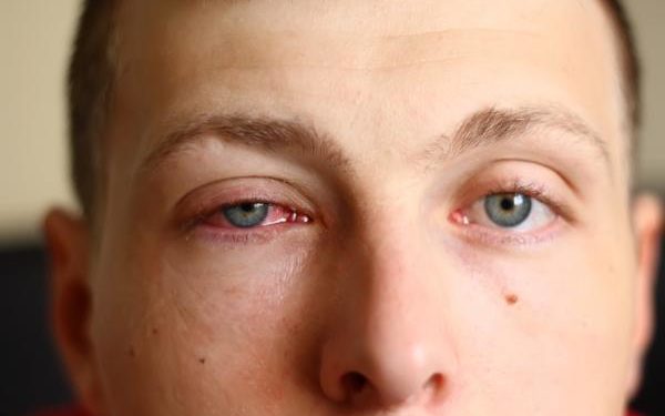 Comment on attrape une conjonctivite bactérienne ?