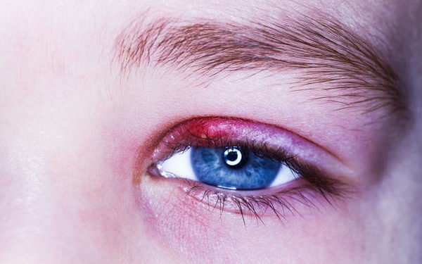 Comment soulager un orgelet naturellement ?