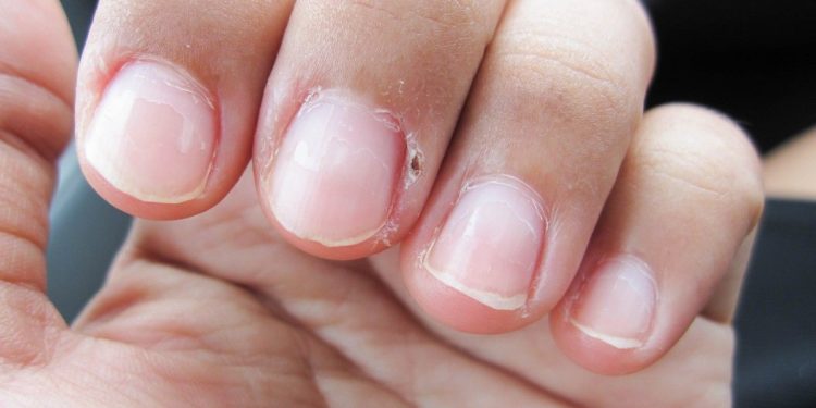 Comment soigner un scarabée ?