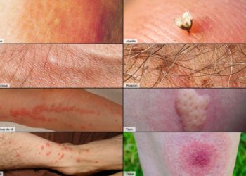 Comment soigner une piqûre d'insecte qui gonfle ?