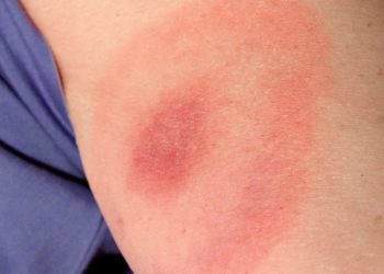 Quelles sont les conséquences d'une morsure de varan ?