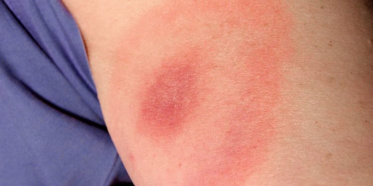 Quelles sont les conséquences d'une morsure de varan ?