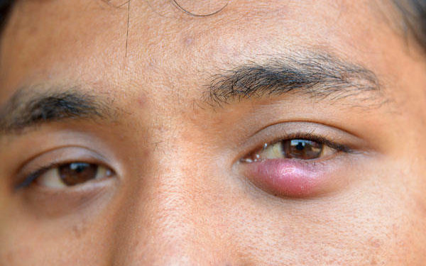 Comment faire partir un orgelet recette de Grand-mère ?