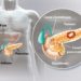 Comment savoir si on a un cancer du pancréas ?