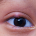 Comment Attrape-t-on un ulcère à l'oeil ?