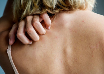 Quel est le traitement le plus efficace contre la gale ?